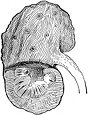 anatomy, diseased kidney engraving